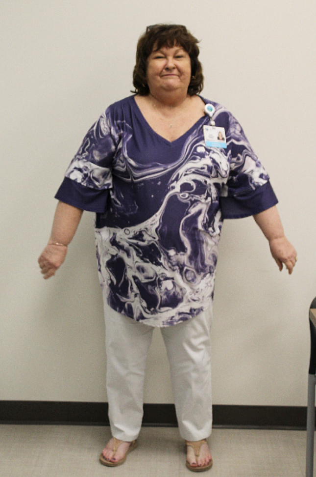 Shirley before her weight loss